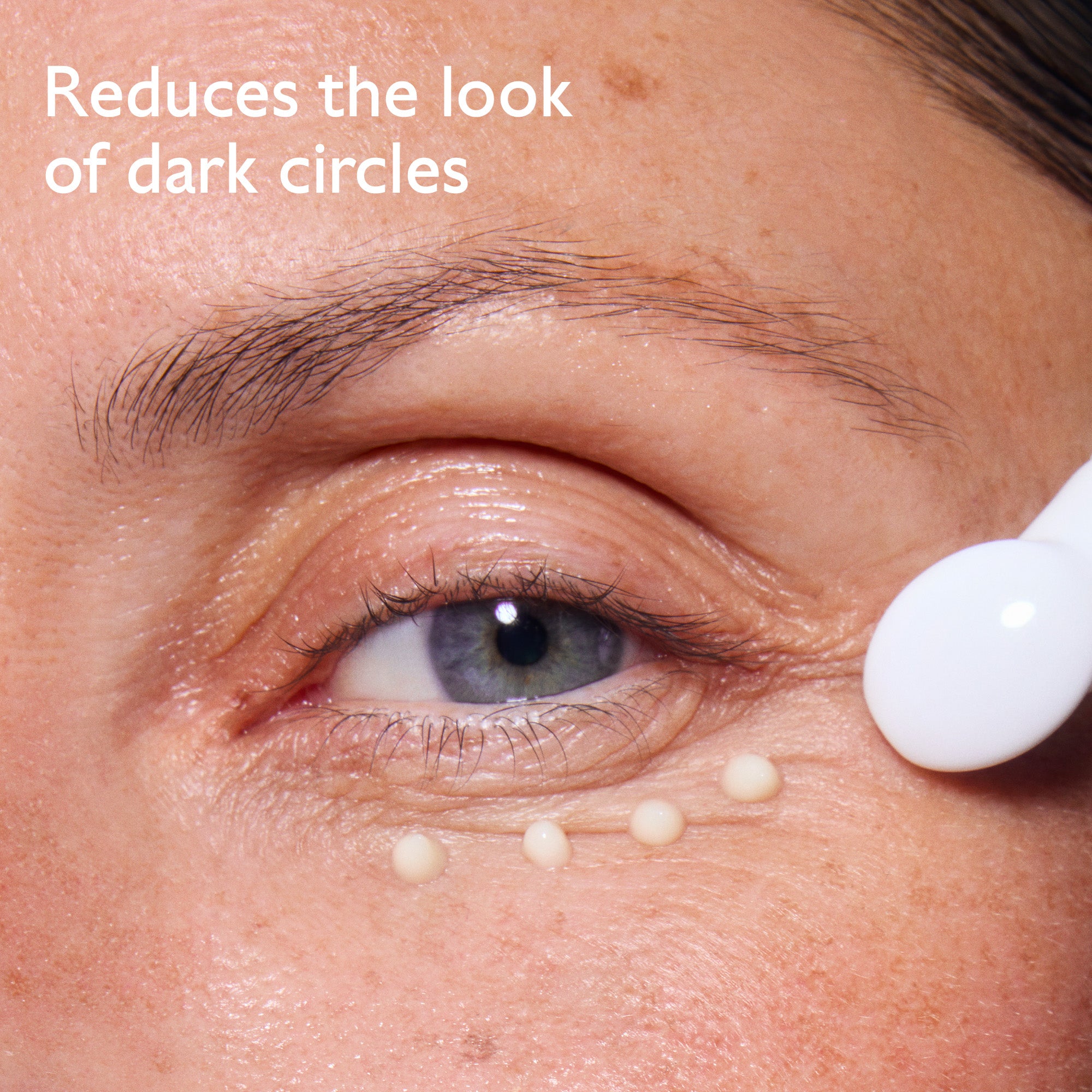 Close-up of eye area with dark circles and a dropper applying cream.