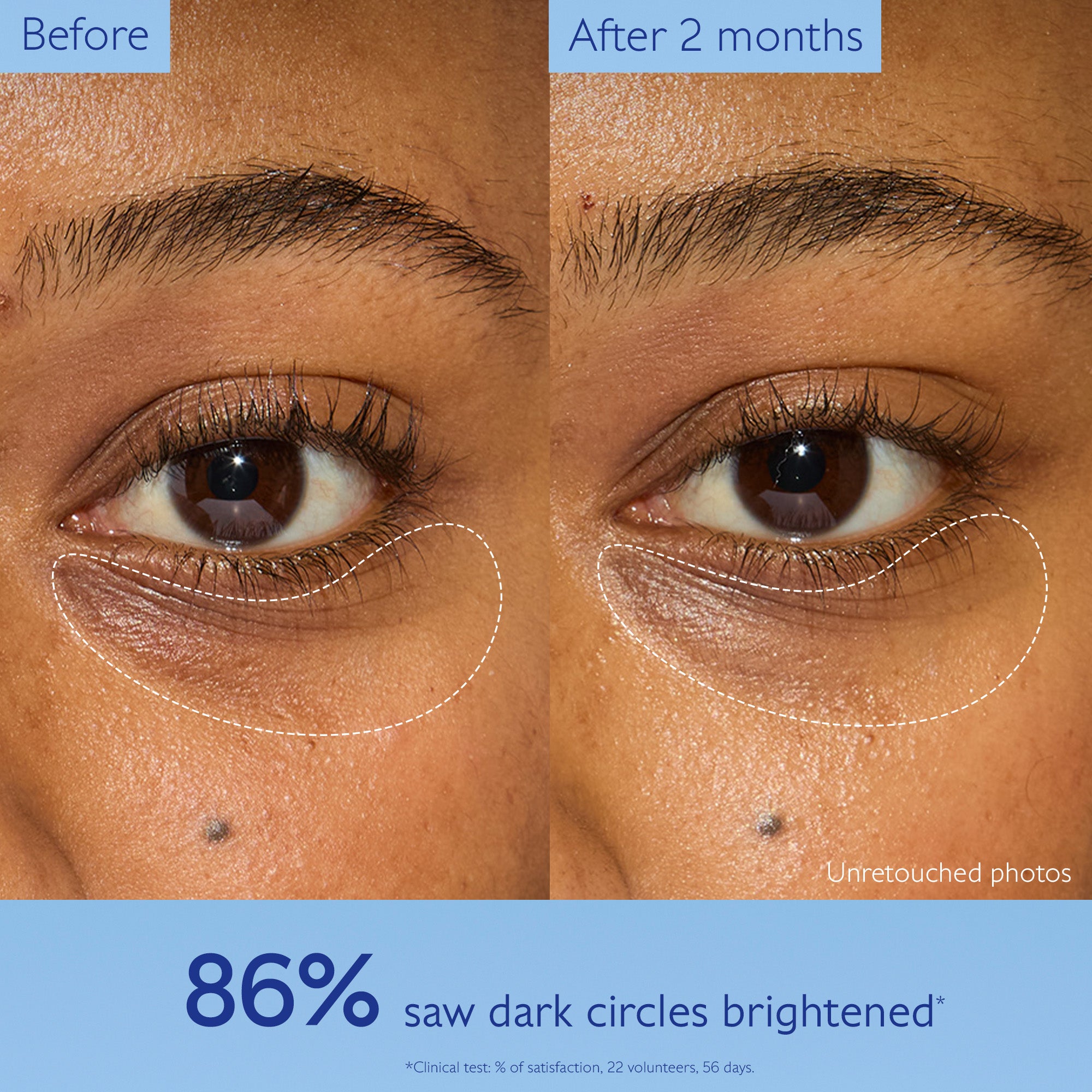 Before and after comparison of dark circles under eyes with text indicating improvement.