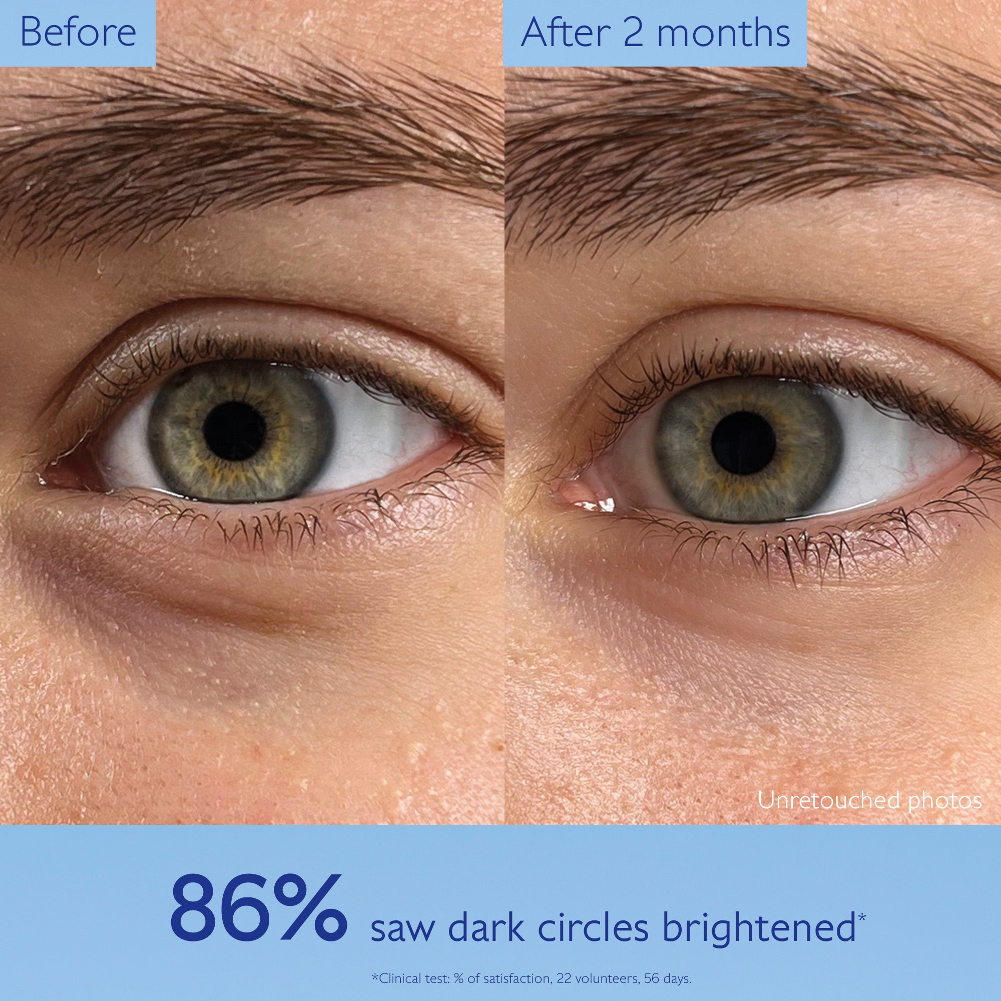 Before and after comparison of dark circles under eyes with text indicating improvement.
