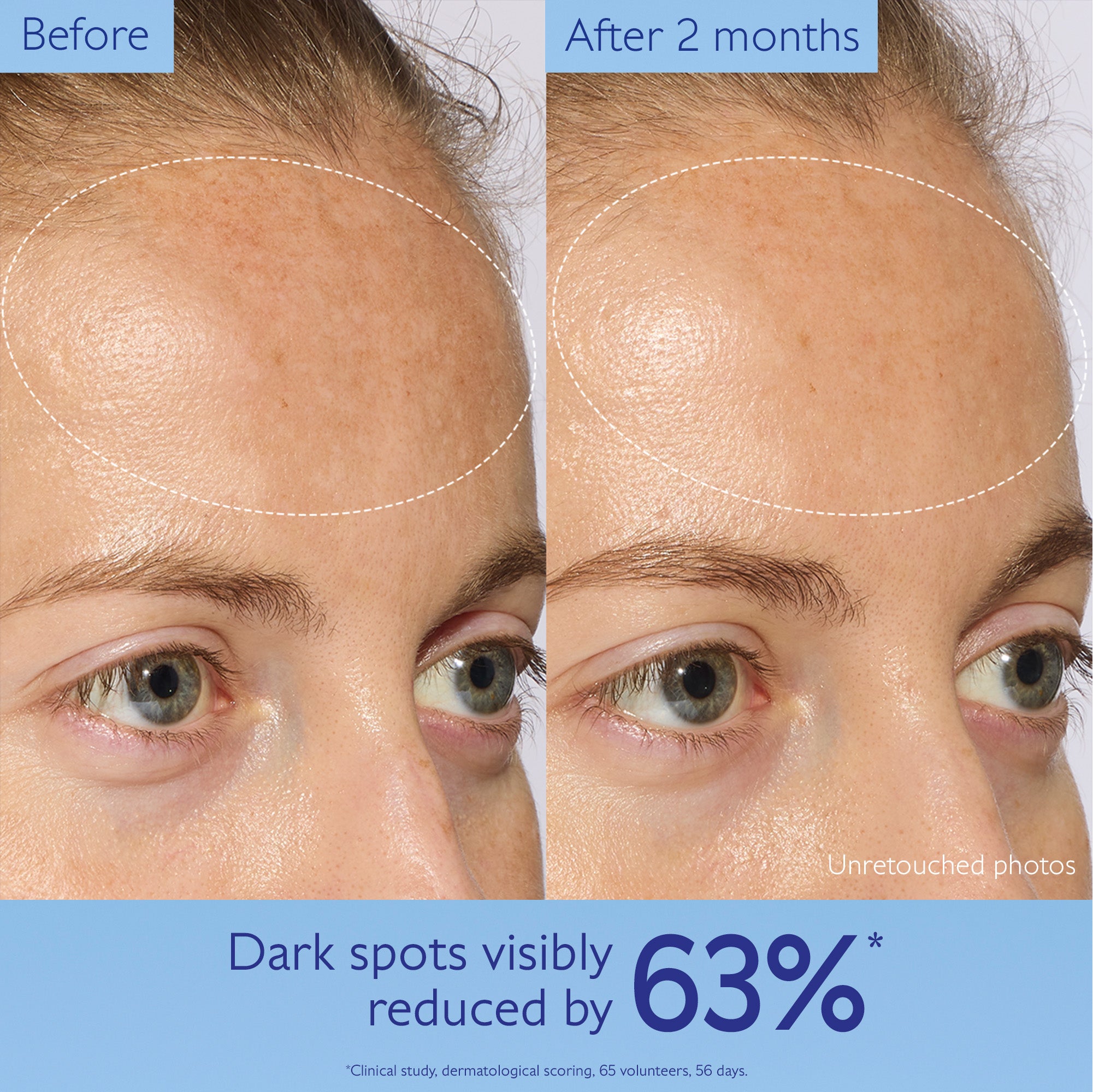 Before and after comparison of a woman's face with dark spots visibly reduced by 63%.