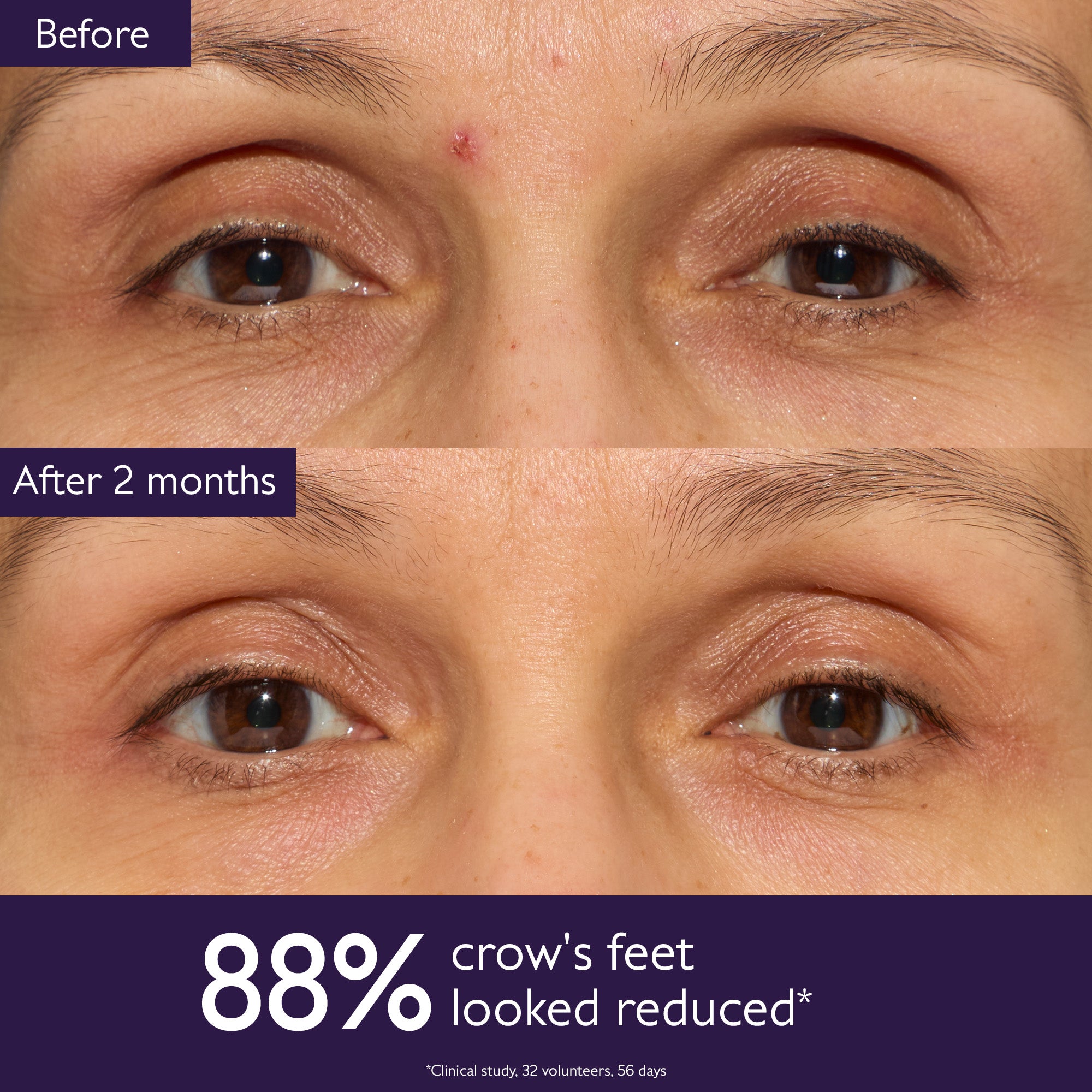 Before and after comparison of crow's feet reduction with text overlay on a close-up of a person's eyes.