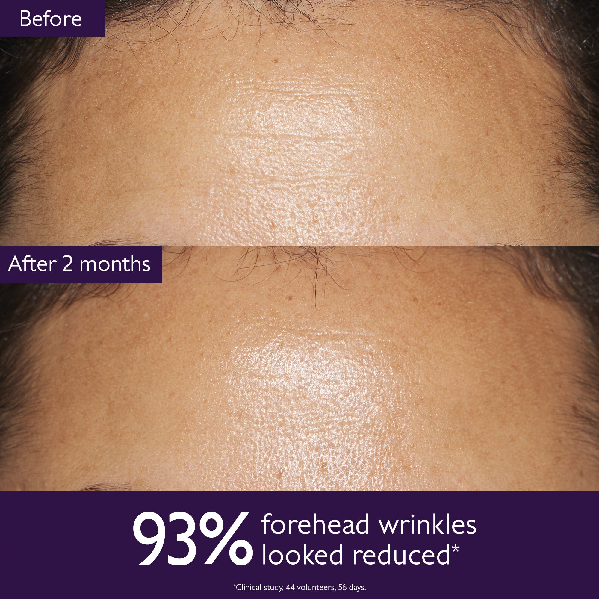 Before and after comparison of forehead wrinkles with text indicating reduction over 2 months.