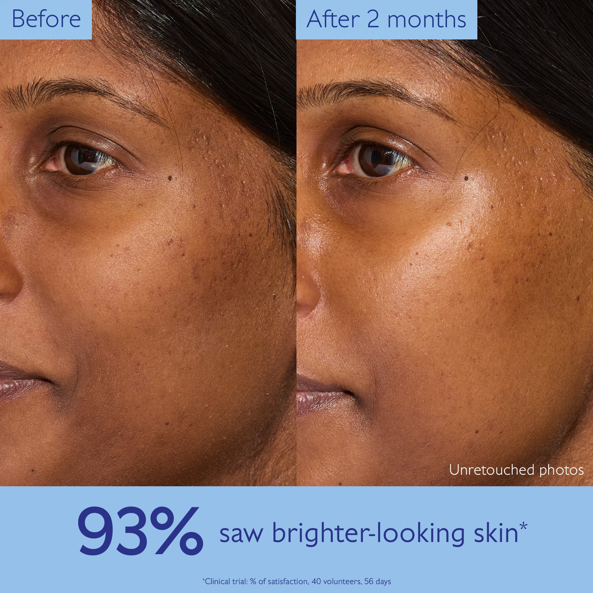Before and after comparison of a person's face with visible skin improvement over 2 months.