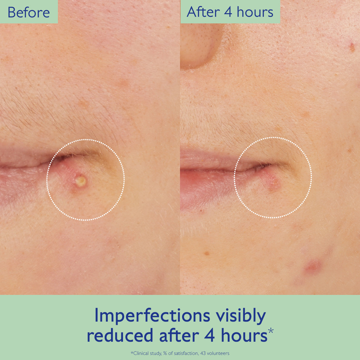 Before and after comparison of skin imperfections with a visible reduction after 4 hours.