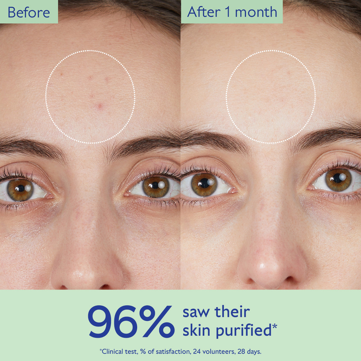 Before and after comparison of a person's eye area with text indicating 96% saw their skin purified.