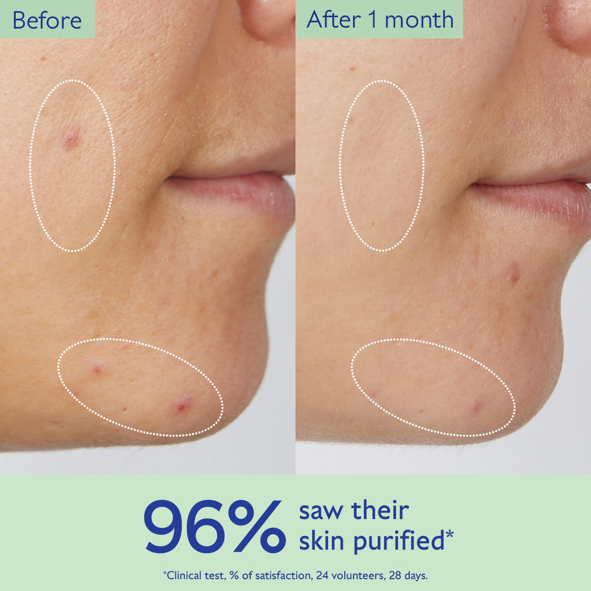Before and after comparison of skin purification with visible improvement on a person's face.
