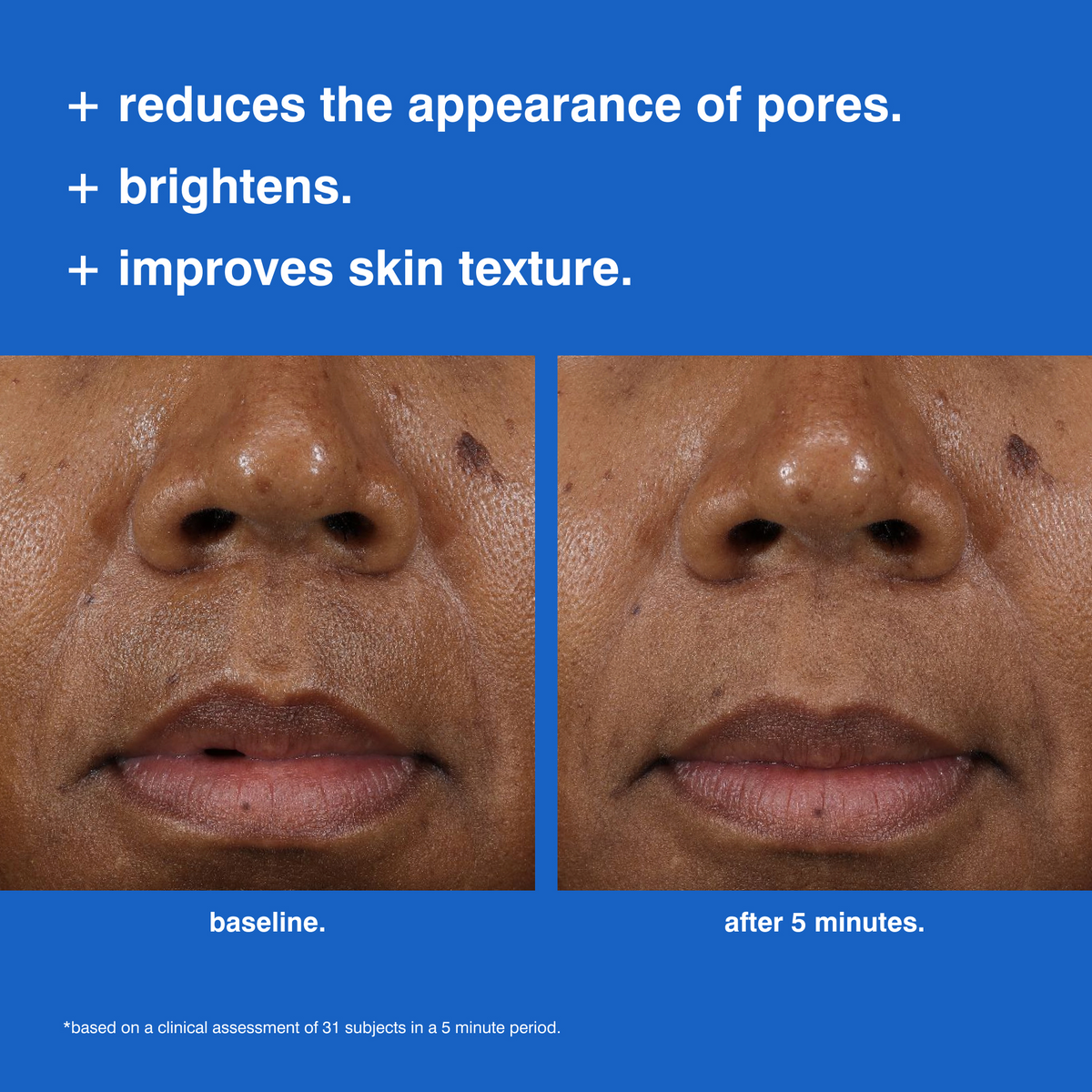Before-and-after comparison of a person's nose and mouth area showing skincare results, with text stating it reduces pores, brightens, and improves skin texture on a blue background.