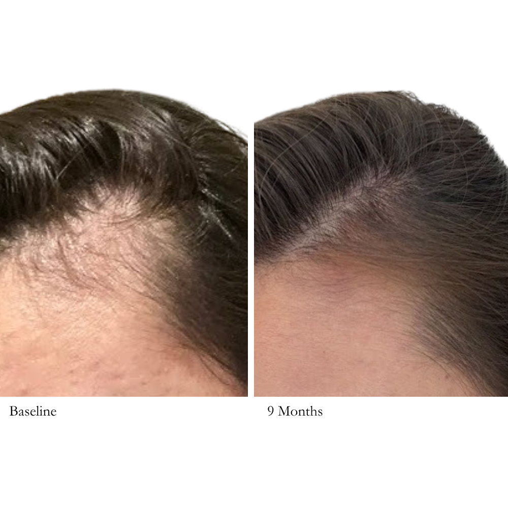 Before and after comparison of hair density on a person's scalp, labeled 'Baseline' and '9 Months'.