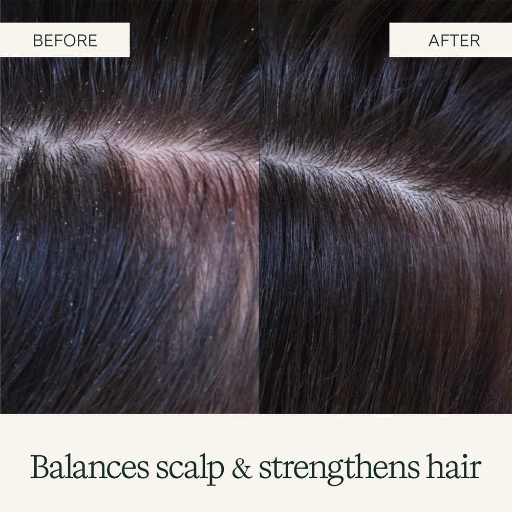 Before and after comparison close-up of a person's dark hair scalp, showing a healthier, less flaky scalp and stronger hair in the 'AFTER' panel, with text reading 'Before' and 'After' and 'Balances scalp & strengthens hair' on a cream background.