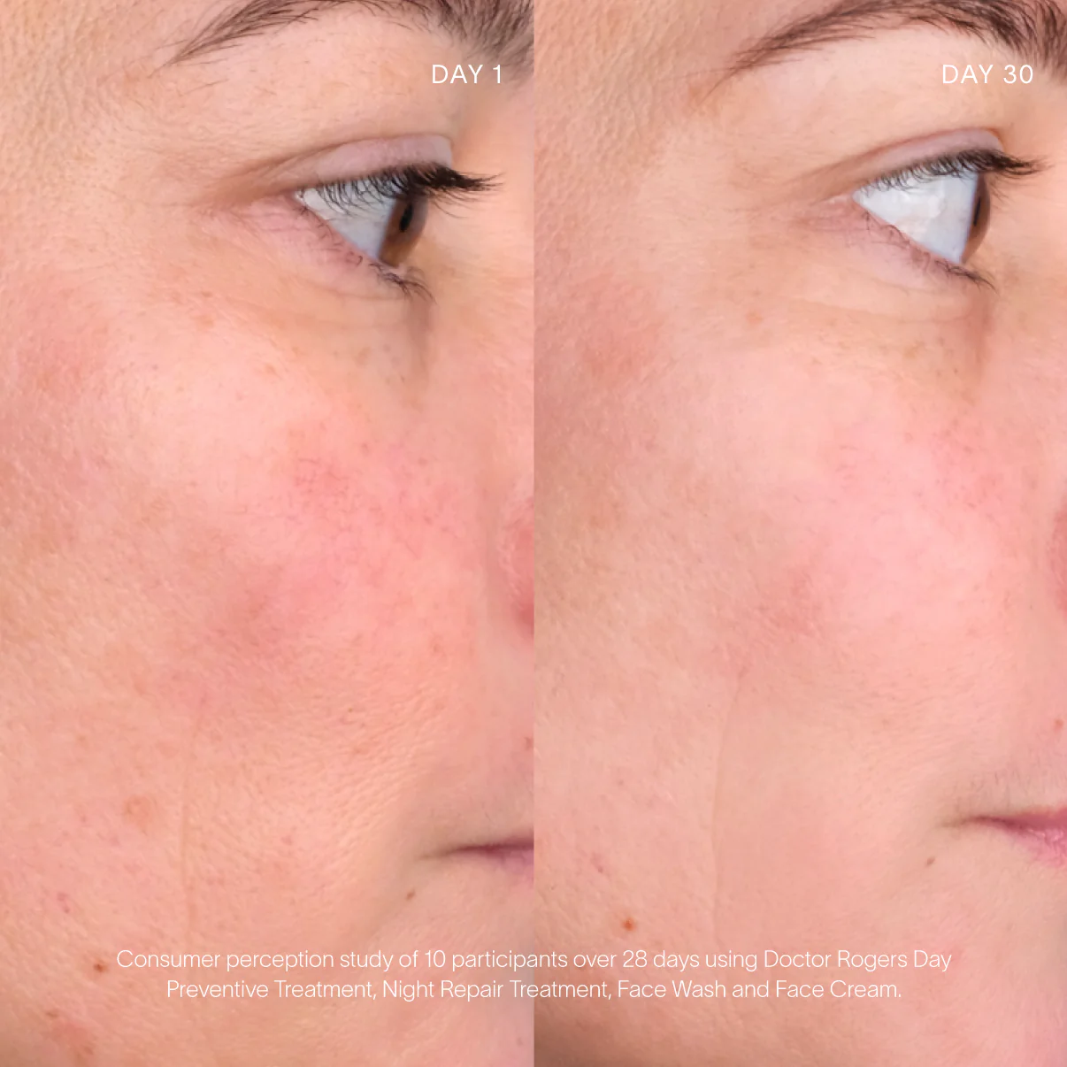 Before and after comparison of skin treatment on a person's face over 30 days.