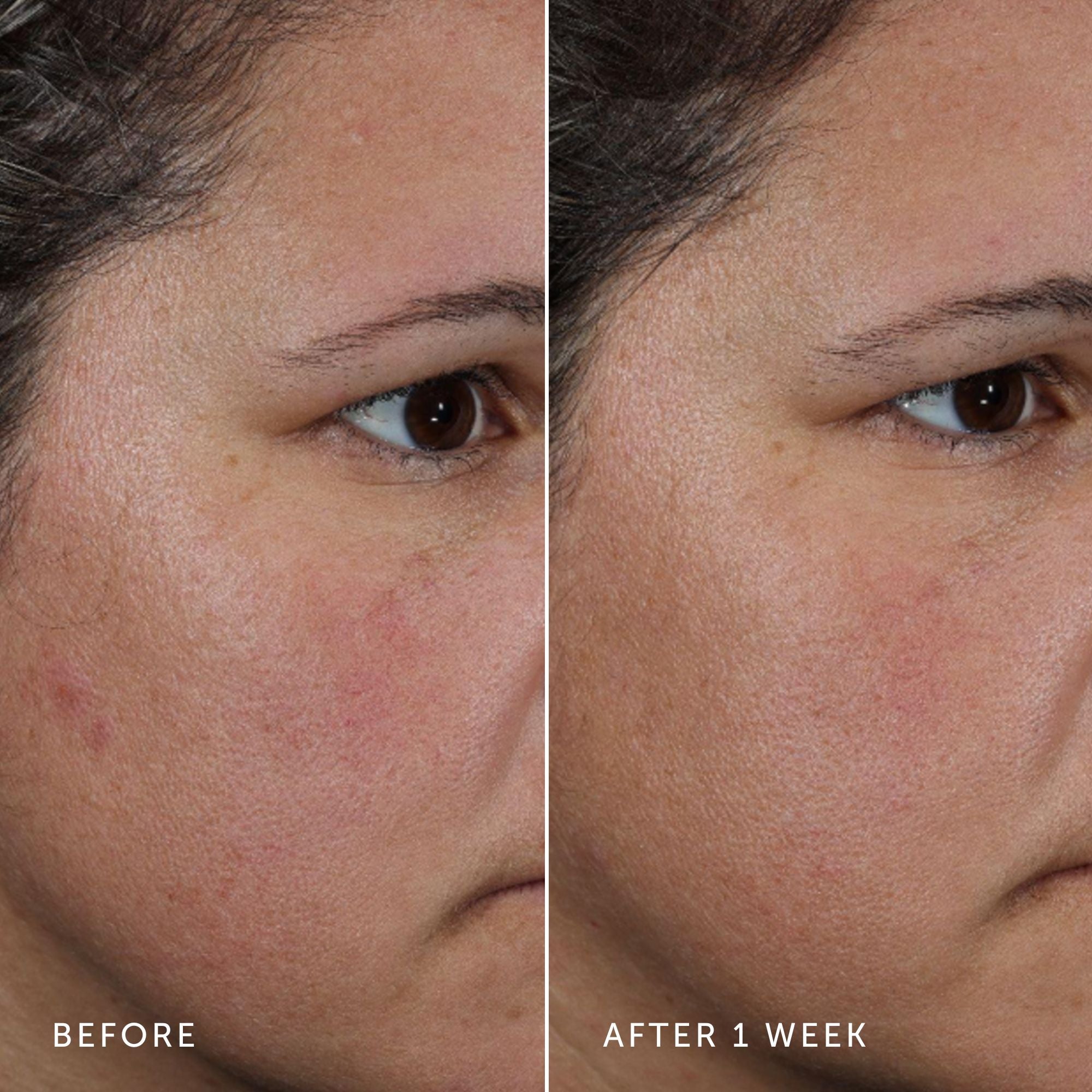 Before and after comparison of a person's face with acne, showing improvement after one week.