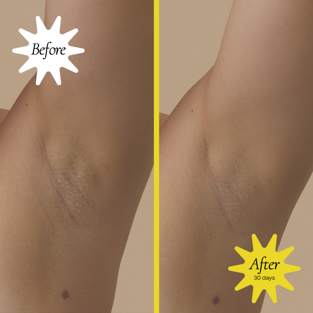 Person's armpit before and after using Biotic Beauty's Brightening Probiotic Deodorant for 30 days.