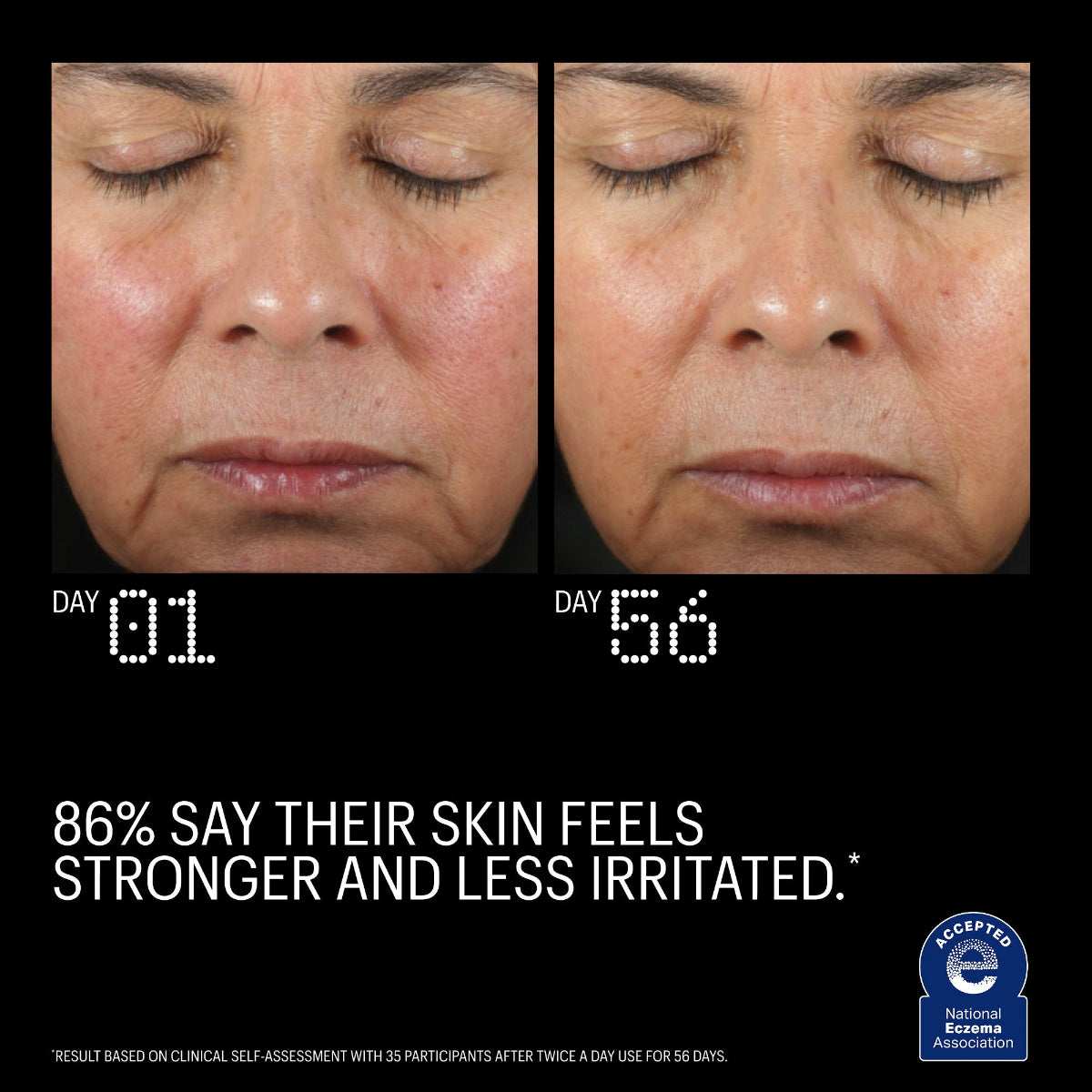 Before and after comparison of a person's skin with text indicating improvement over 56 days.
