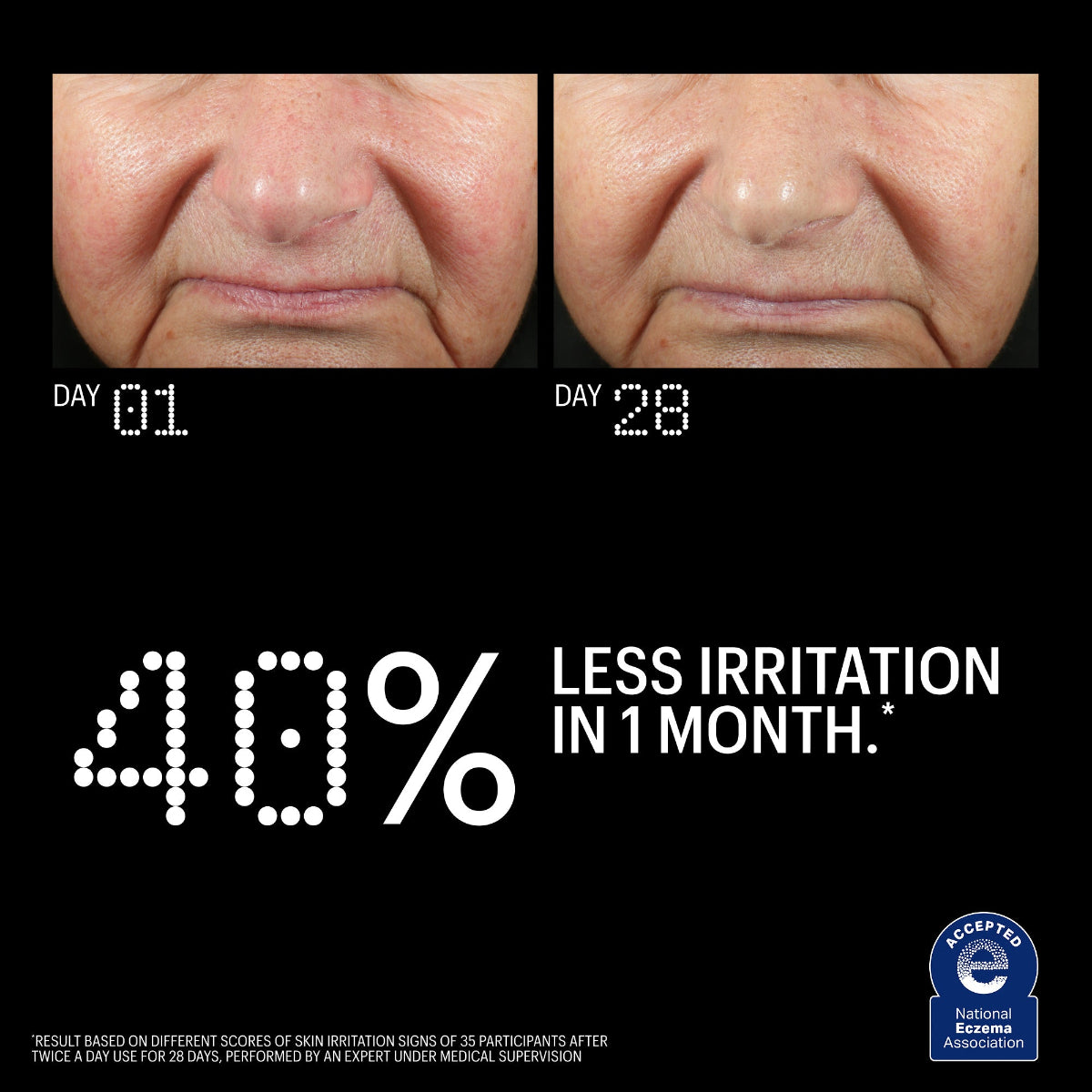 l carnitine skin rash Search Results: vitamin K, or multiple lesions, 50-59 year old Female Copper Tripeptide and Ectoin Advanced
