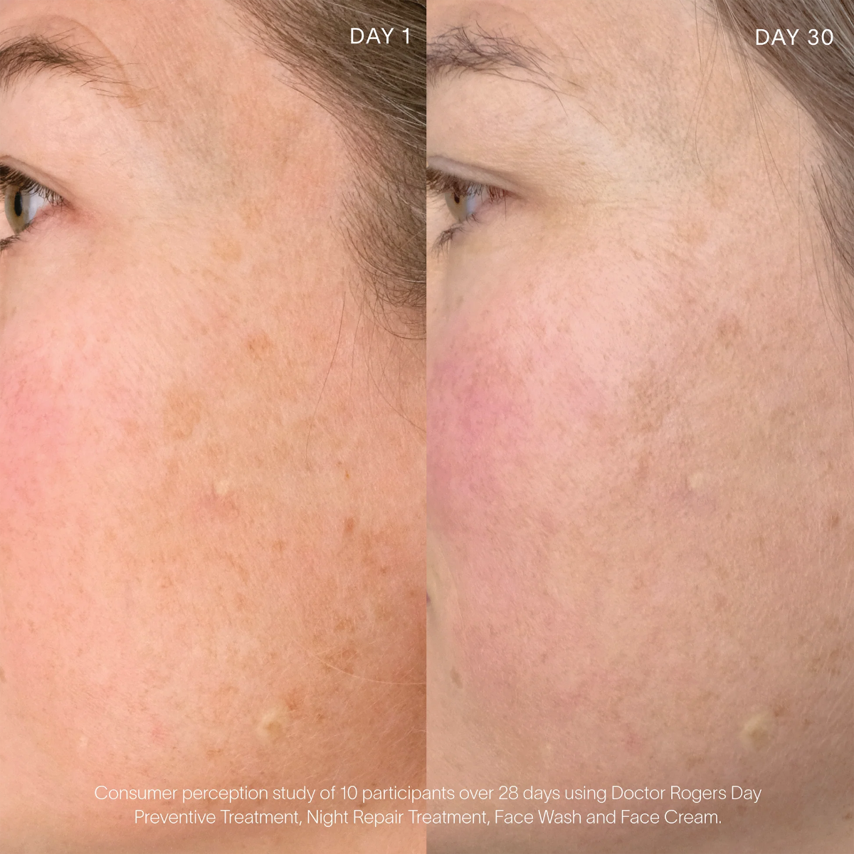 Before and after comparison of skin texture on a person's face using a skincare treatment over 30 days.