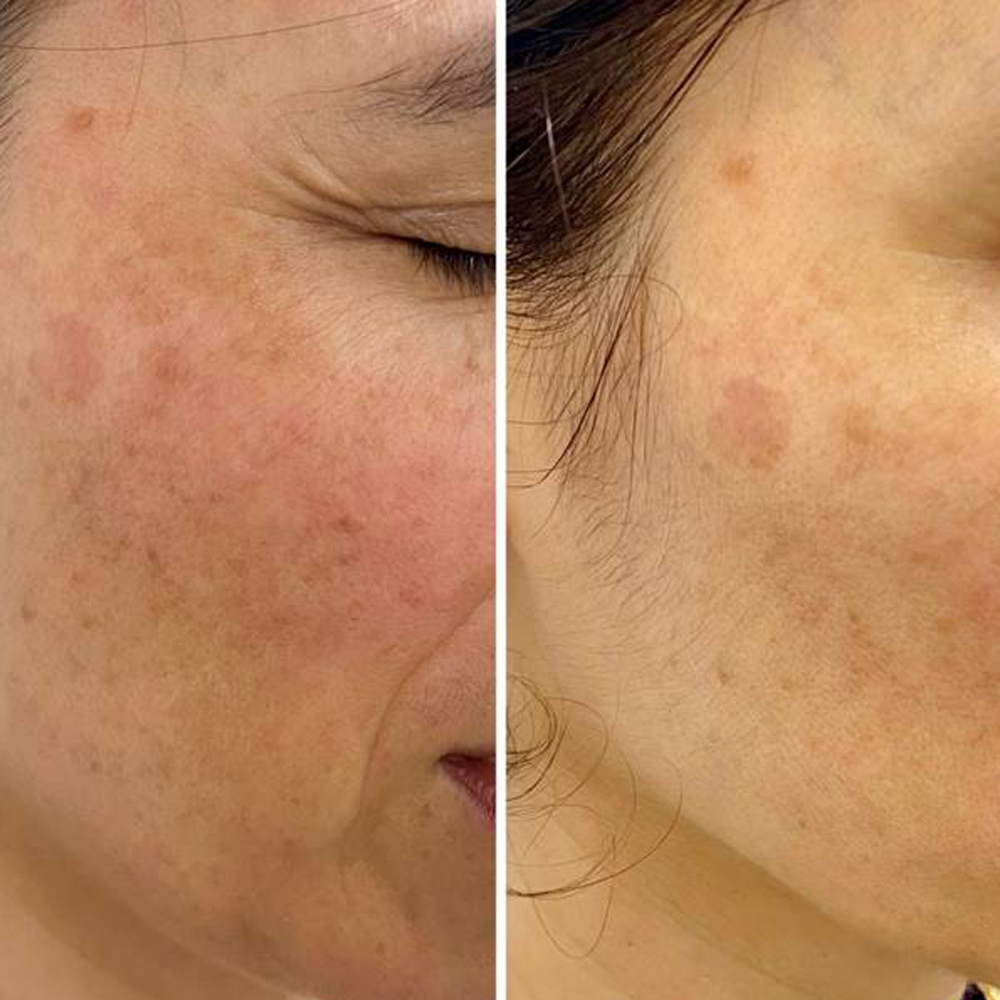 A close-up before-and-after style comparison of a person's cheek, showing visible skin texture, freckles, and redness in the left panel and smoother, clearer skin in the right panel.