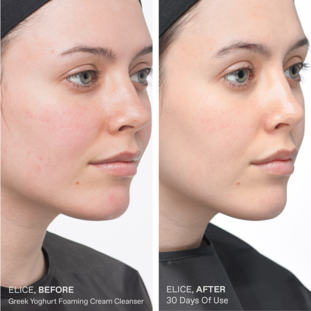 Before and after comparison of a person's face using a Greek Yoghurt Foaming Cream Cleanser.