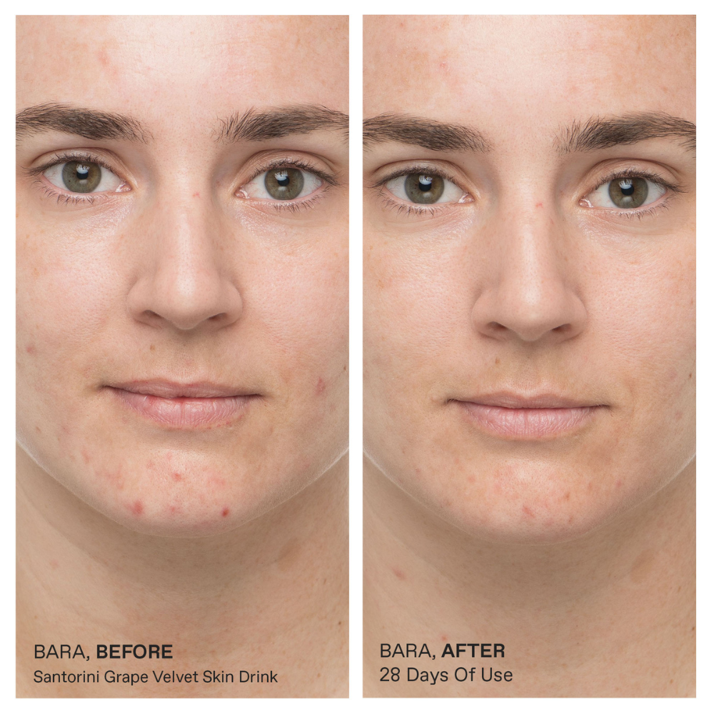 Before and after comparison of a person's face with acne treatment using Korres product.