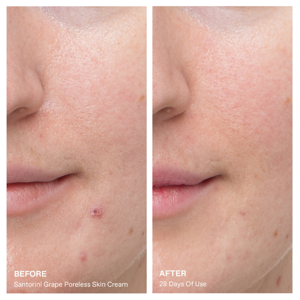 A side-by-side before and after comparison of a person's cheek and mouth area, showing skin improvement over 28 days of use of Santorini Grape Poreless Skin Cream.