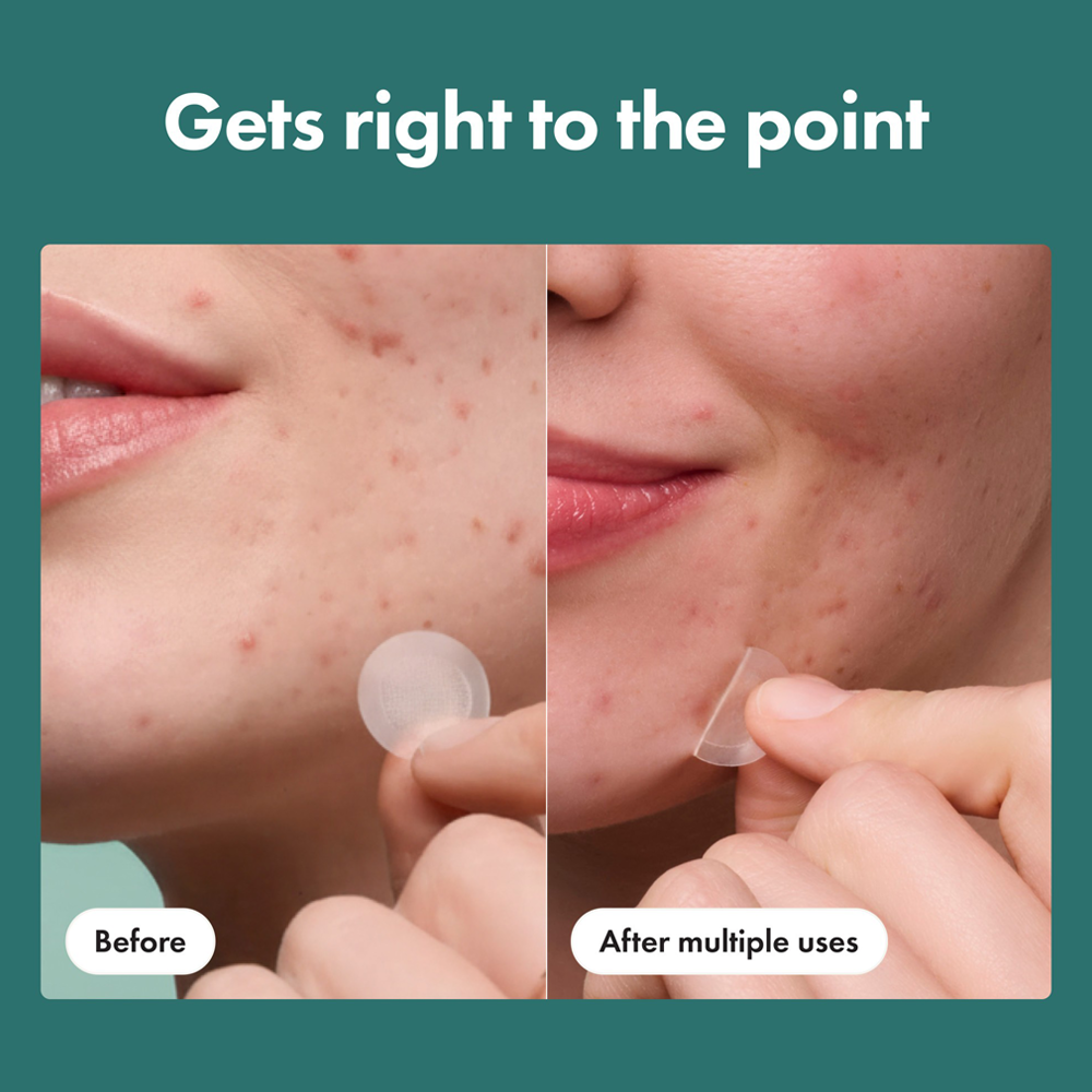Micropoint for Blemishes