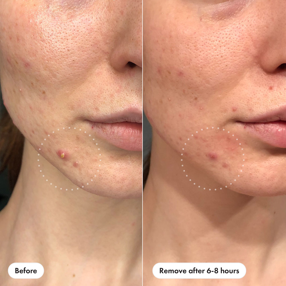 Before and after comparison of skin with acne, showing a close-up of a person's face.