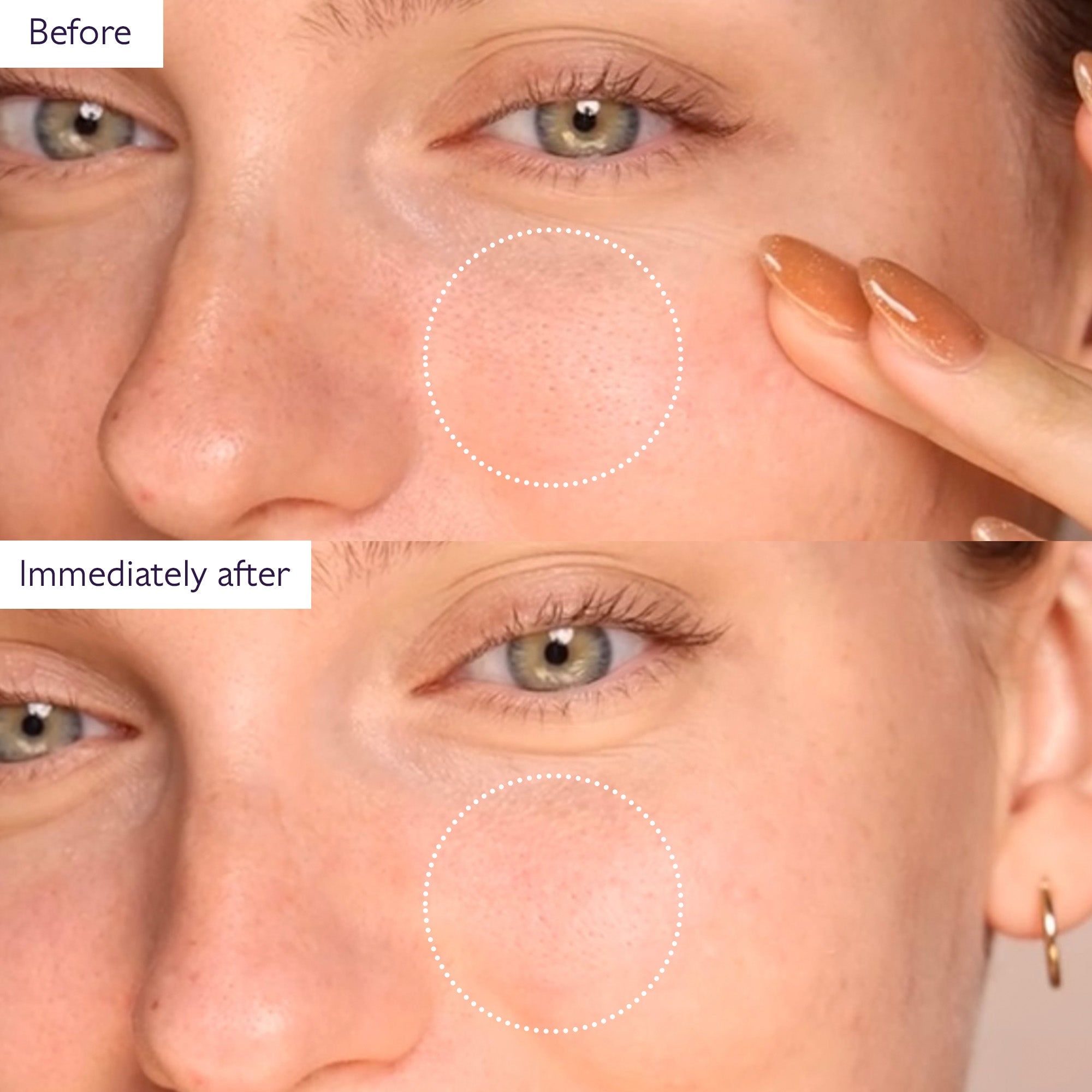 Before and after comparison of a woman's face with a focus on a blemish.