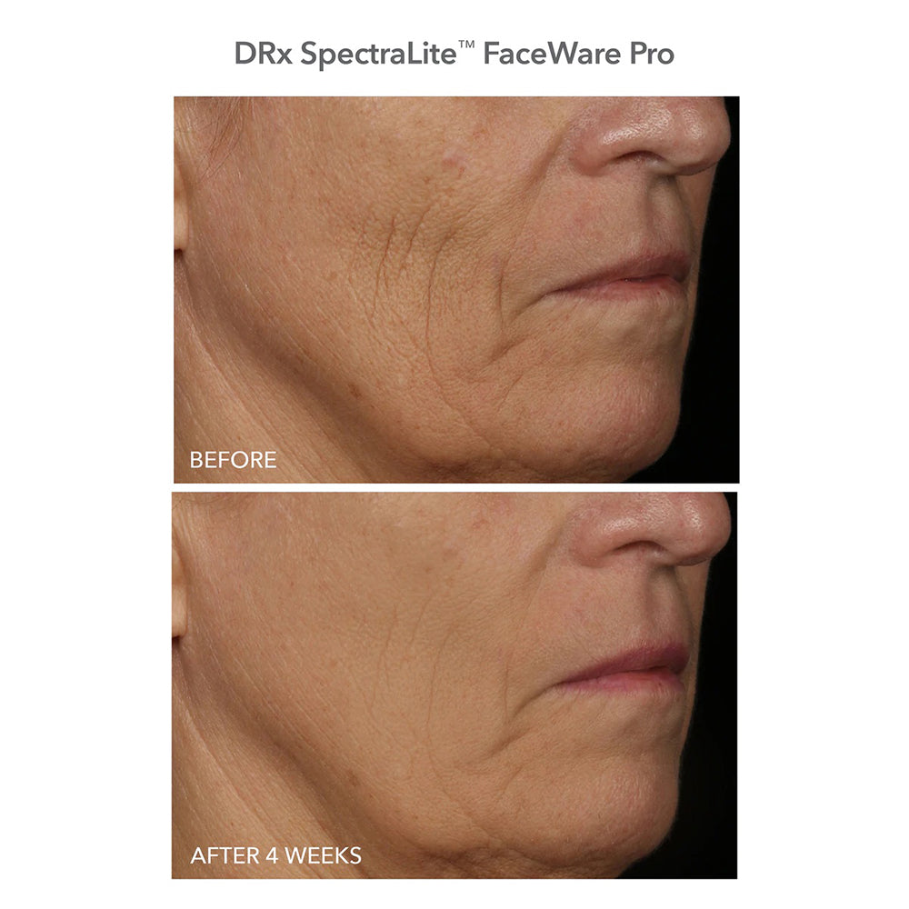 Drx SpectraLite FaceWare PRO